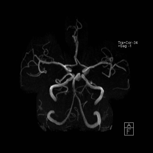 Basilar tip aneurysm (Radiopaedia 26504-26632 D 6).jpg