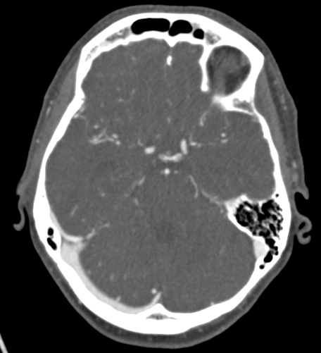 File:Basilar tip aneurysm with coiling (Radiopaedia 53912-60086 A 53).jpg