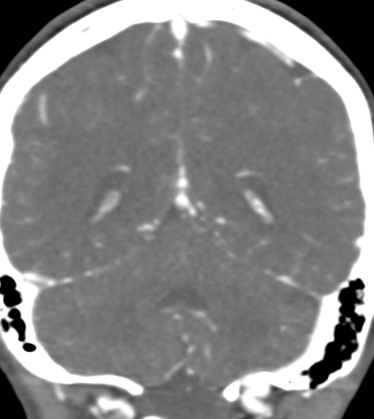 Basilar tip aneurysm with coiling (Radiopaedia 53912-60086 B 111).jpg
