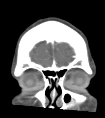 Basilar tip aneurysm with coiling (Radiopaedia 53912-60086 B 7).jpg