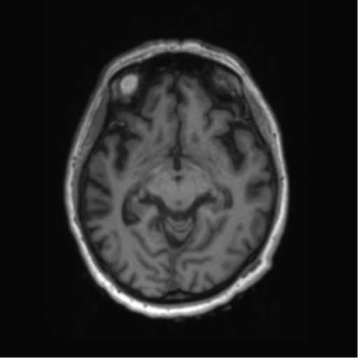 Behavioral variant frontotemporal dementia and late onset schizophrenia (Radiopaedia 52197-58083 Axial T1 61).png