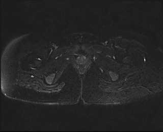 File:Bicornuate bicollis uterus (Radiopaedia 61626-69616 Axial PD fat sat 33).jpg