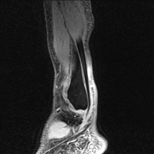 Bilateral Achilles tendon complete tear (Radiopaedia 81344-95051 Sagittal WE - Left 97).jpg
