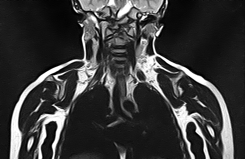 File:Bilateral Sprengel deformity with Klippel-Feil syndrome (Radiopaedia 66395-75650 Coronal T2 12).jpg