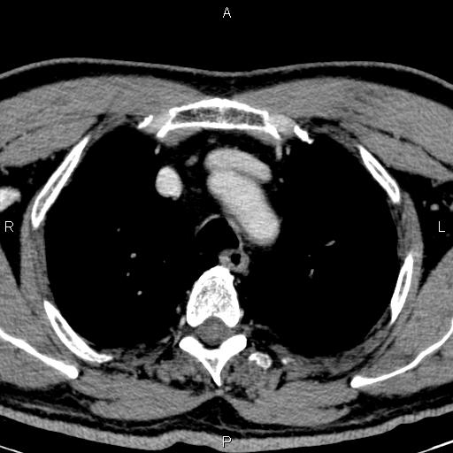 Bilateral Warthin tumors (Radiopaedia 84034-99263 Axial With contrast 74).jpg