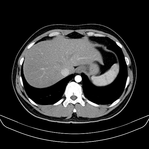 Bilateral accessory renal arteries with mild pelvi-ureteric junction (PUJ) obstruction (Radiopaedia 66357-75596 A 3).jpg