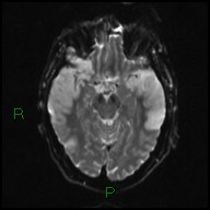 File:Bilateral acute middle cerebral artery territory infarcts (Radiopaedia 77319-89402 Axial DWI 10).jpg
