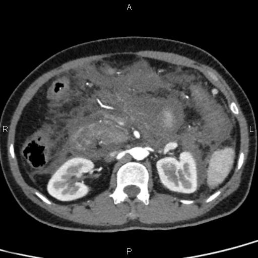 Bilateral adrenal gland hyperenhancement in pancreatitis (Radiopaedia 86642-102753 B 56).jpg