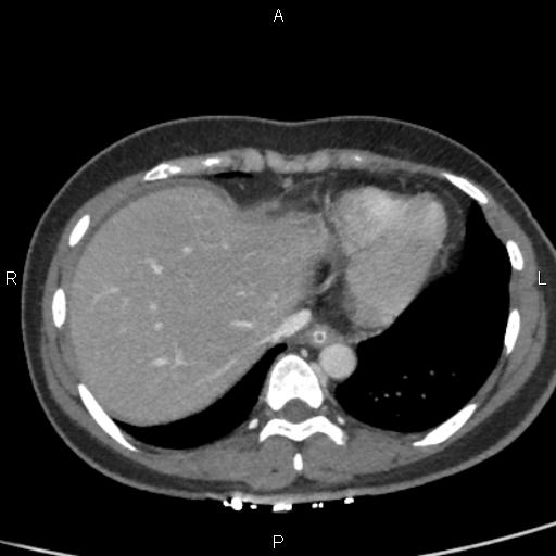 File:Bilateral adrenal gland hyperenhancement in pancreatitis (Radiopaedia 86642-102753 E 9).jpg