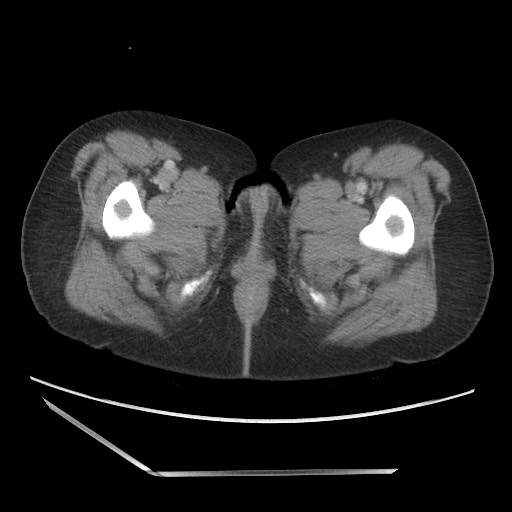 Bilateral adrenal granulocytic sarcomas (chloromas) (Radiopaedia 78375-91007 A 133).jpg