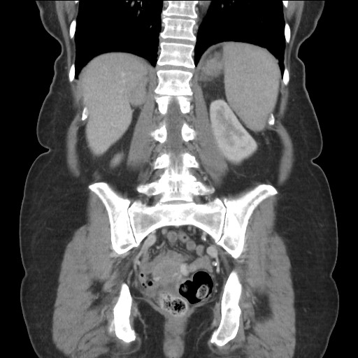 Bilateral adrenal granulocytic sarcomas (chloromas) (Radiopaedia 78375-91007 B 66).jpg