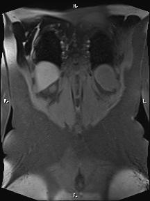 Bilateral adrenal myelolipoma (Radiopaedia 63058-71537 Coronal T1 fat sat 14).jpg