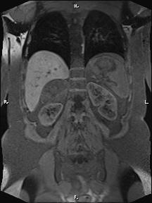 Bilateral adrenal myelolipoma (Radiopaedia 63058-71537 Coronal T1 fat sat 33).jpg