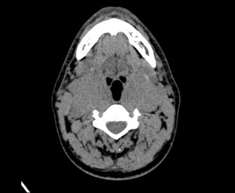 Bilateral carotid body tumors (Radiopaedia 61841-69870 Axial non-contrast 46).jpg