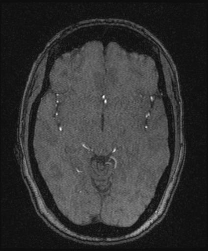 Bilateral carotid body tumors and right glomus jugulare tumor (Radiopaedia 20024-20060 Axial MRA 85).jpg