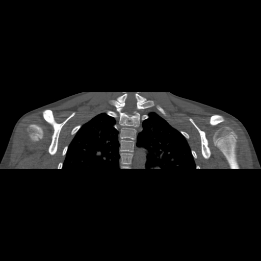 Bilateral chronic posterior shoulder dislocation (Radiopaedia 39213-41452 Coronal bone window 37).jpg