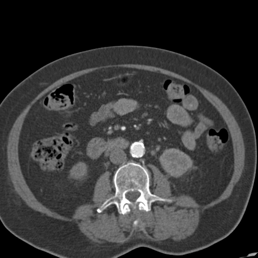 Bilateral delayed nephrogram from renal artery stenosis (Radiopaedia 47681-52362 A 30).png