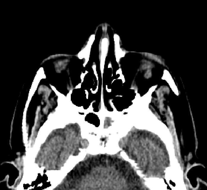 Bilateral ectopia lentis (Radiopaedia 89889-107013 Axial non-contrast 66).jpg