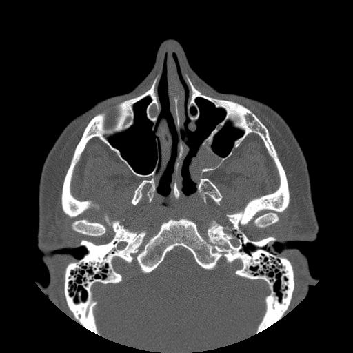 File:Bilateral ectopic infraorbital nerves (Radiopaedia 49006-54084 Axial 2).jpg