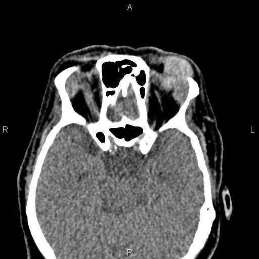 File:Bilateral enlargement of lacrimal glands - sarcoidosis (Radiopaedia 62627-70921 Axial non-contrast 56).jpg