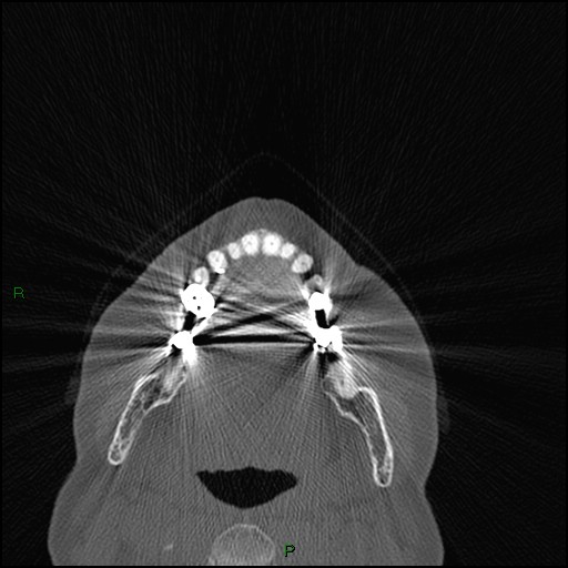 Bilateral frontal mucoceles (Radiopaedia 82352-96454 Axial bone window 275).jpg