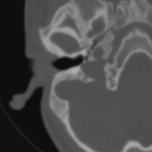 Bilateral otosclerosis (Radiopaedia 57237-64157 B 37).jpg