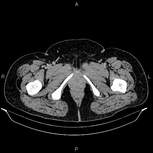 Bilateral ovarian dermoid cysts (Radiopaedia 85785-101603 A 115).jpg