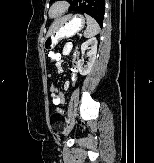 File:Bilateral ovarian dermoid cysts (Radiopaedia 85785-101603 D 67).jpg
