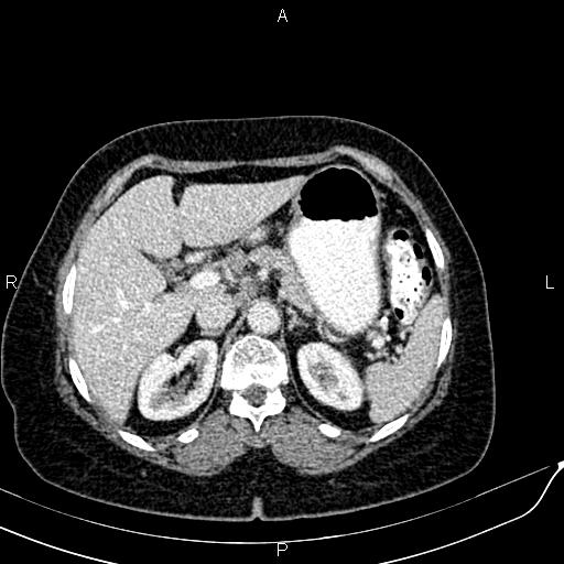 Bilateral ovarian serous cystadenocarcinoma (Radiopaedia 86062-101989 B 28).jpg