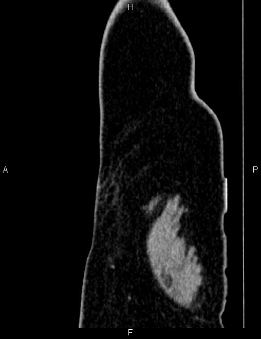 Bilateral ovarian teratoma (Radiopaedia 83131-97503 D 113).jpg