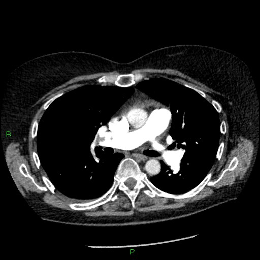 Bilateral pulmonary emboli (Radiopaedia 32700-33669 Axial C+ CTPA 49).jpg