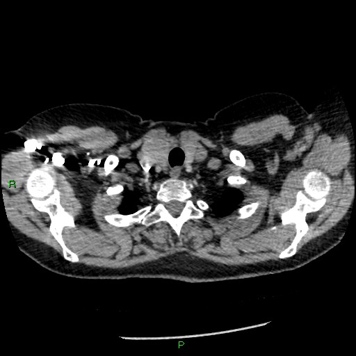 Bilateral pulmonary emboli (Radiopaedia 32700-33669 Axial C+ CTPA 7).jpg