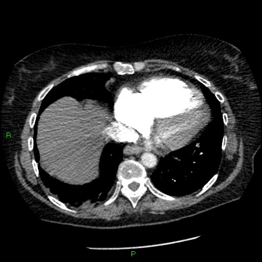 File:Bilateral pulmonary emboli (Radiopaedia 32700-33669 Axial C+ CTPA 82).jpg