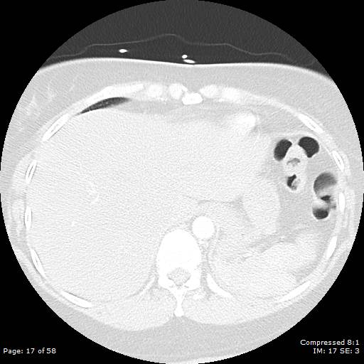 Bilateral pulmonary emboli with Hampton hump sign (Radiopaedia 54070-60246 Axial lung window 17).jpg