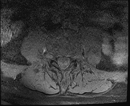 File:Bing-Neel syndrome (Radiopaedia 71453-81799 Axial T1 fat sat 4).jpg