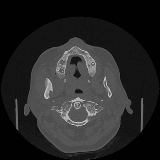 File:Bisphosphonate-related osteonecrosis of the jaw (Radiopaedia 71324-81642 Axial bone window 108).jpg