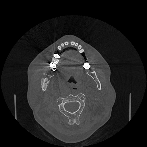 File:Bisphosphonate-related osteonecrosis of the jaw (Radiopaedia 71324-81642 Axial bone window 83).jpg