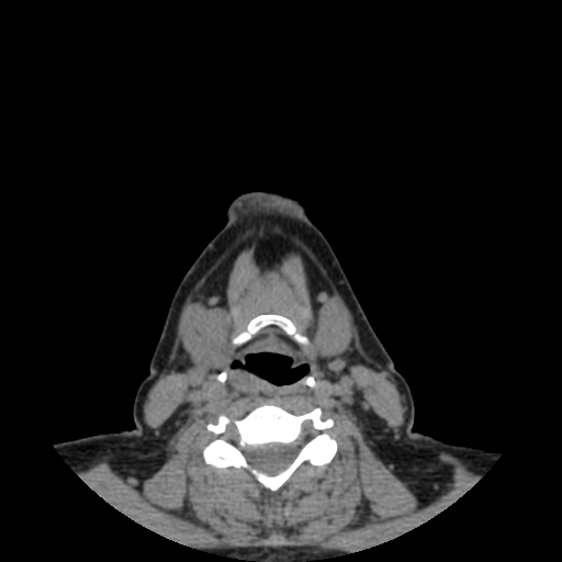 Bisphosphonate-related osteonecrosis of the jaw (Radiopaedia 71324-81642 non-contrast 2).jpg