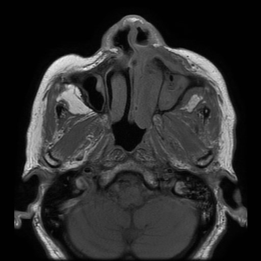Bisphosphonate-related osteonecrosis of the maxilla (Radiopaedia 51367-57101 Axial T1 28).jpg
