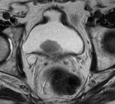 File:Bladder cancer invading the ureteral ostium (Radiopaedia 14168-14026 Axial T2 1).jpg