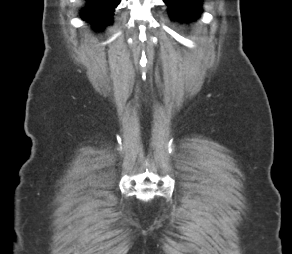 File:Bladder papillary urothelial carcinoma (Radiopaedia 48119-52951 C 57).png