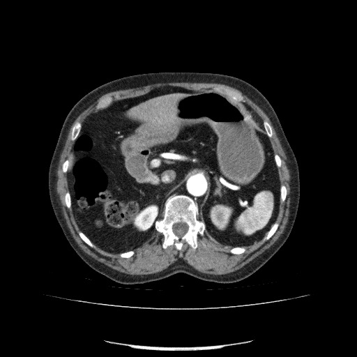 Bladder tumor detected on trauma CT (Radiopaedia 51809-57609 A 90).jpg