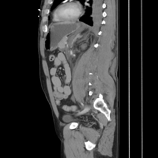 File:Blunt abdominal trauma with solid organ and musculoskelatal injury with active extravasation (Radiopaedia 68364-77895 C 91).jpg