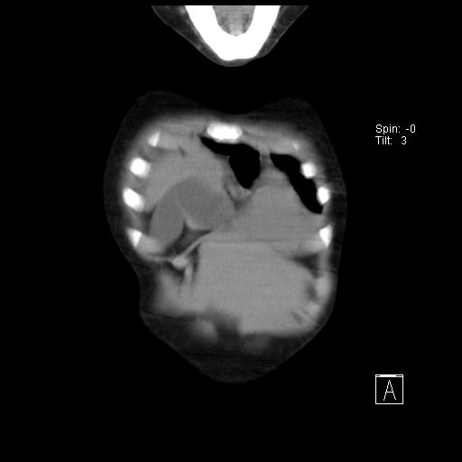 File:Bochdalek diaphragmatic hernia (Radiopaedia 38866-41059 Coronal liver window 2).jpg