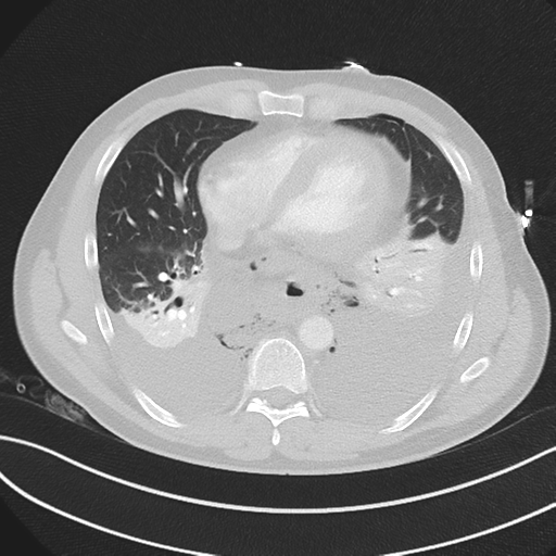 Boerhaave syndrome (Radiopaedia 39382-41660 Axial lung window 36).png