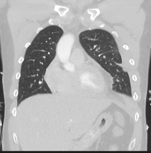 Boerhaave syndrome (Radiopaedia 39382-41661 Coronal lung window 16).png