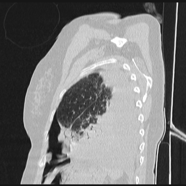 Boerhaave syndrome (Radiopaedia 45644-49799 Sagittal lung window 71).jpg