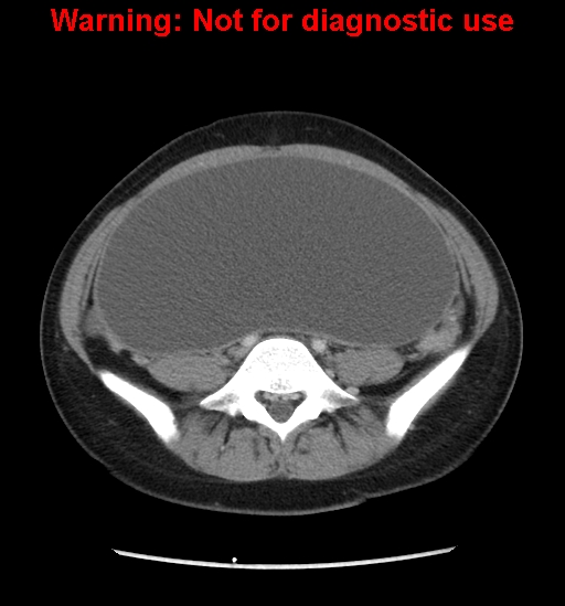 Borderline mucinous cystadenoma of ovary (Radiopaedia 25586-25767 A 59).jpg