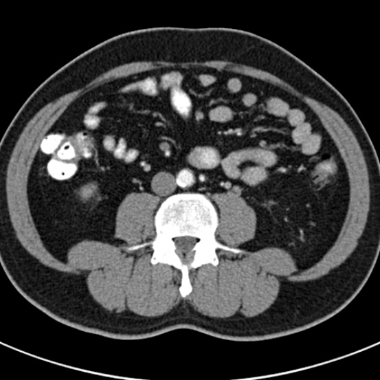 File:Bosniak cyst - type IV (Radiopaedia 23525-23627 renal cortical phase 46).jpg
