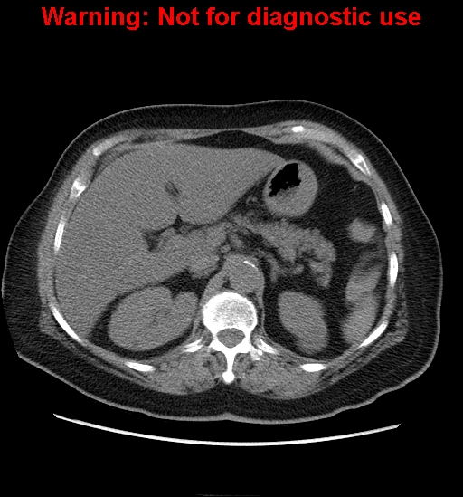 File:Bosniak renal cyst - type II (Radiopaedia 23404-23468 Axial non-contrast 5).jpg